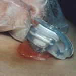 Mild granulation example 1