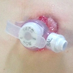 Mild granulation example 2