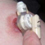 Mild granulation example 3