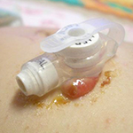 Moderate granulation