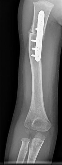 Radiograph of a Rotational Osteotomy with stainless steel plate and screws in humerus