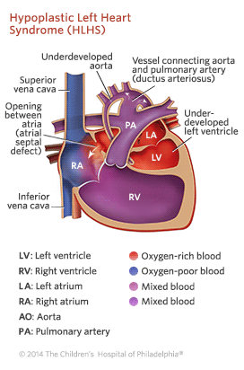 Hypoplastic Left Heart Syndrome Illustration