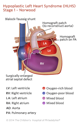 Hypoplastic Left Heart Syndrome Stage 1 Repair Illustration