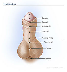 Hypospadias