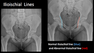 Illioischial line