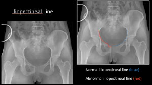 Iliopectineal line