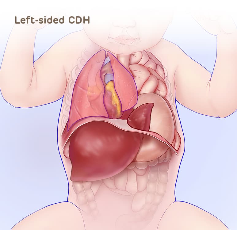 Left-sided CDH