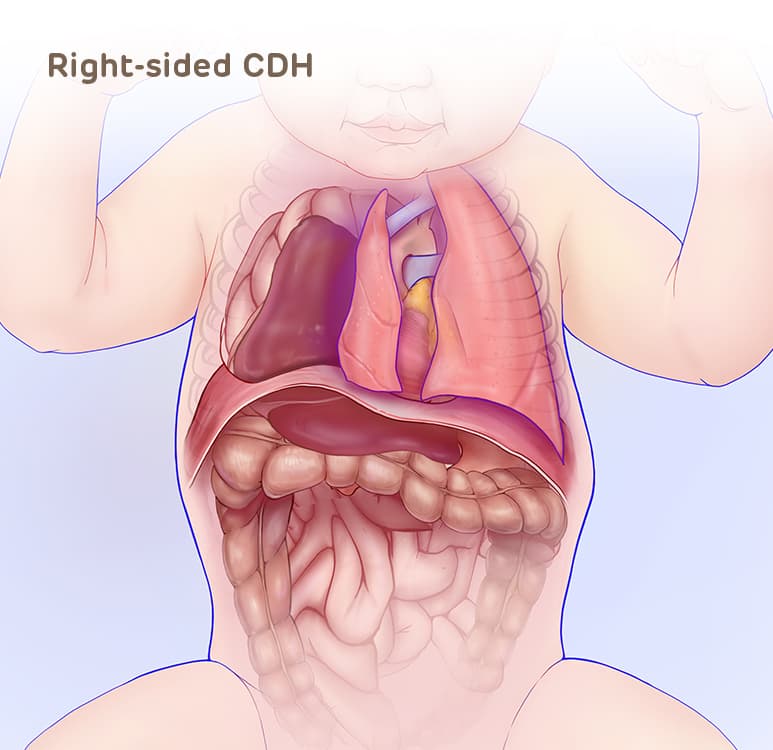 Right-sided CDH