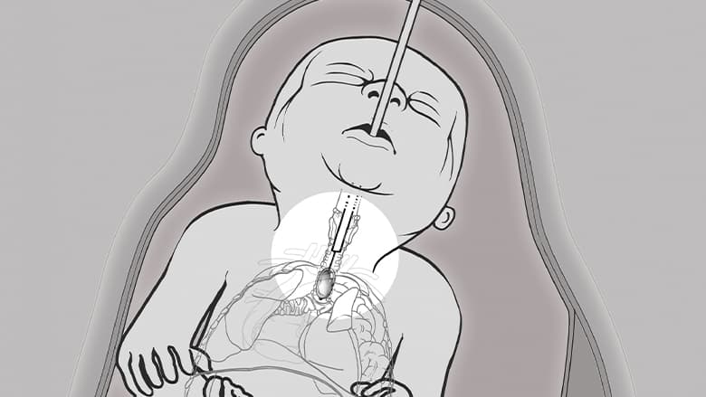 Fetoscopic endoluminal tracheal occlusion