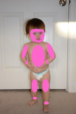 Lesion distribution, infants and toddlers