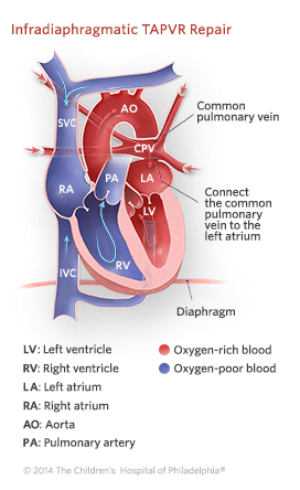 Infradiaphragmatic TAPVR Repair