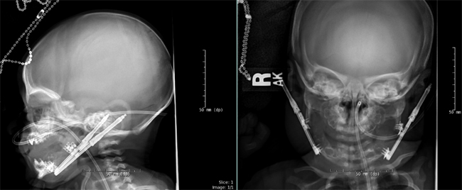 Internal Distractors and Arms in Place