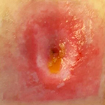 Irritant dermatitis example 1