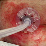 Irritant dermatitis example 2