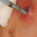 Severe enlargement example 1