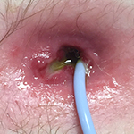 Severe enlargement example 3