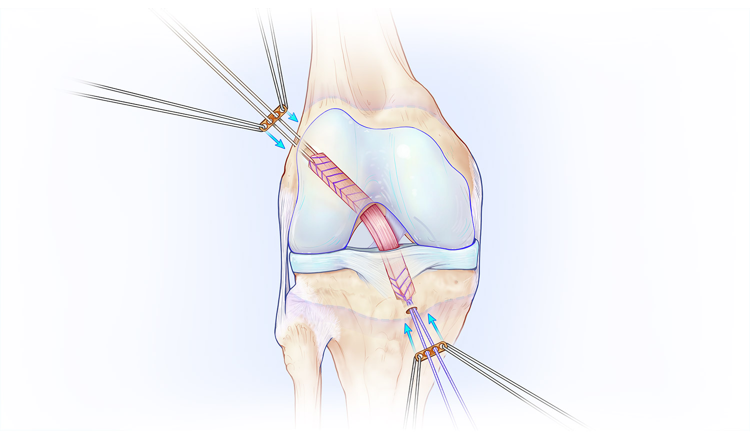 Fig. 2: The replacement tissue graft is passed diagonally through small tunnels in the thigh and shin bones and secured in place.