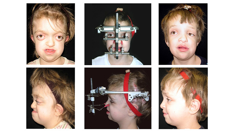 Le Fort III and Monobloc Advancement treated by Distraction Osteogenesis