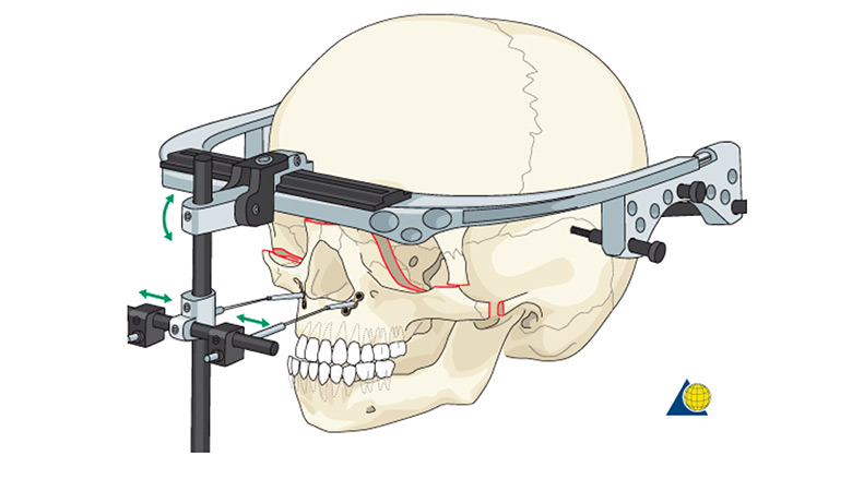 demonstration of Le Fort III and Monobloc advancement with Distraction Osteogenesis