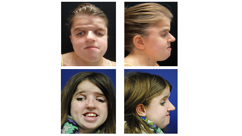 Le Fort III treatment in a teenager