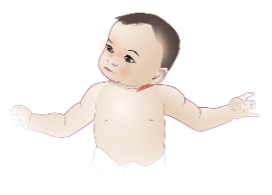 Left Torticollis: Head tilt to left, rotation to right