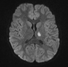 MRA of left thalamic stroke