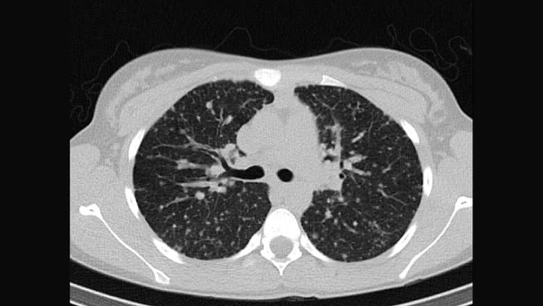 CT scan of thyroid after Lenvatinib use