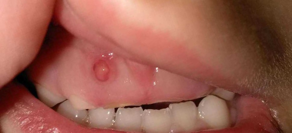 Localized inflammation. Dental infection.