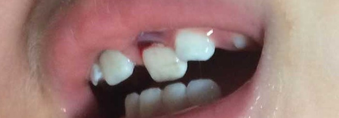 Lateral luxation