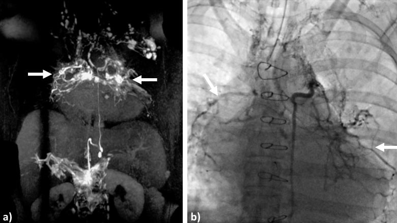 Magnetic Resonance Lymphangiography