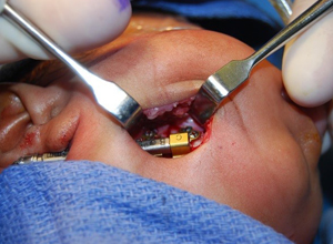 MDO placement in the OR
