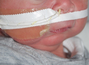 Moderate Micrognathia before MDO