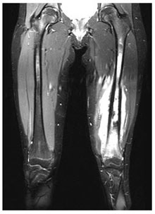 knee mri