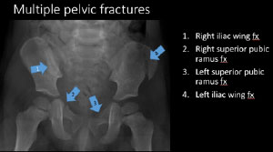 Multiple Pelvic Fractures