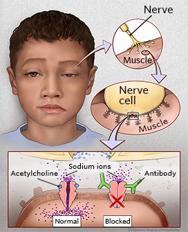 myasthenia gravis illustration