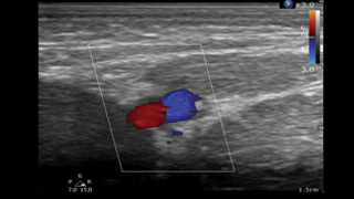 Neonatal Ultrasound Program - PICC line placememt