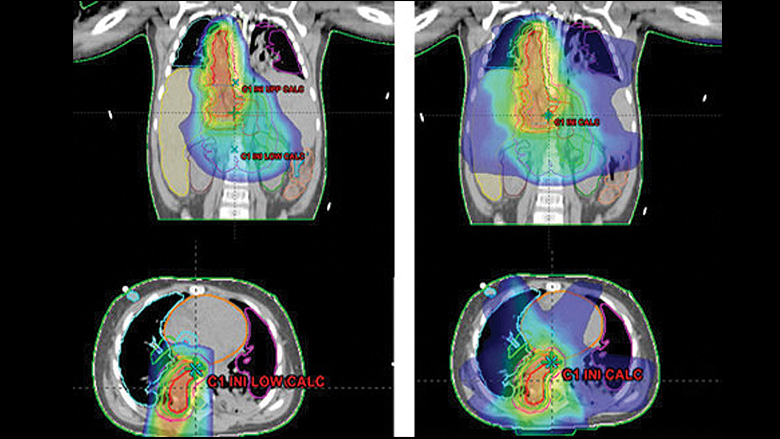 radiation treatment plans