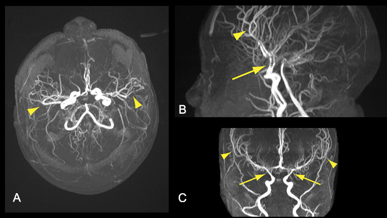 MR angiogram sequence - Neonatal Neurocritical Care Team