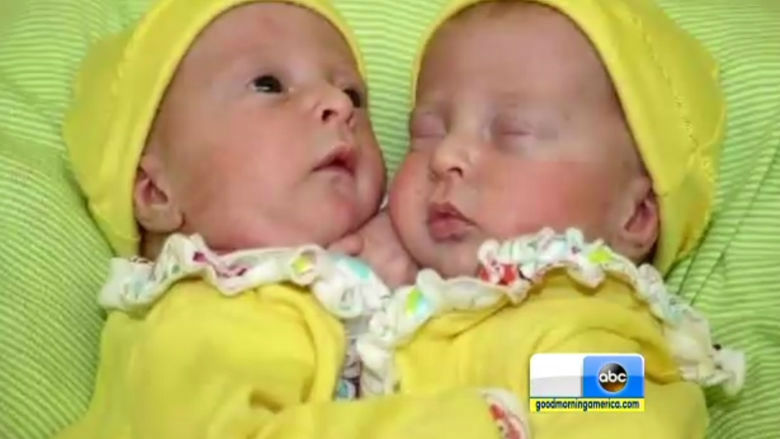 conjoined infant twins