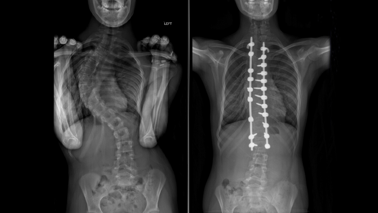 xrays showing idiopathic scoliosis