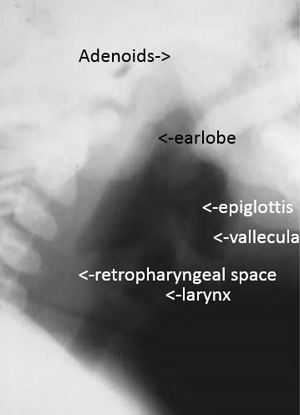 Normal upper airway anatomy
