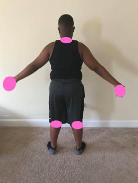Lesion distribution, back of older children