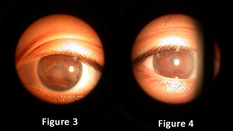 Partners In Preventing Eye Disease: Rheumatology And Ophthalmology