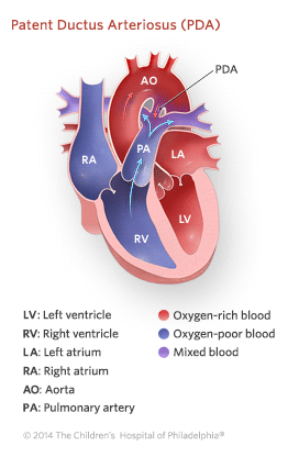 Patent Ductus Arteriosus Illustration