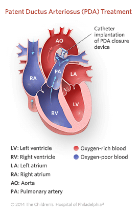 Patent Ductus Arteriosus (PDA) | Children's Hospital of Philadelphia