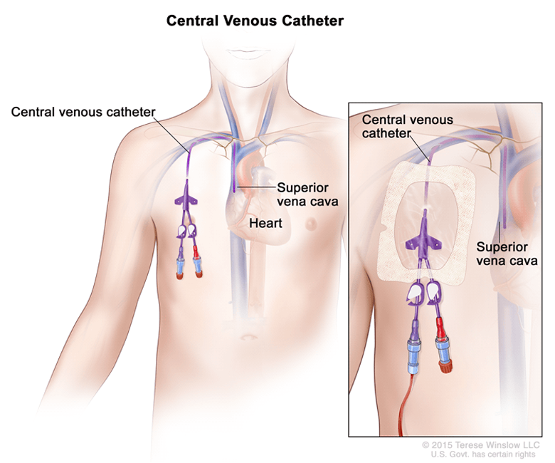 Tunneled Central Line (Tunneled Central Venous Catheter) | Children's Hospital of Philadelphia Tunneled Central Line (Tunneled Central Venous Catheter) | Children'S Hospital Of Philadelphia