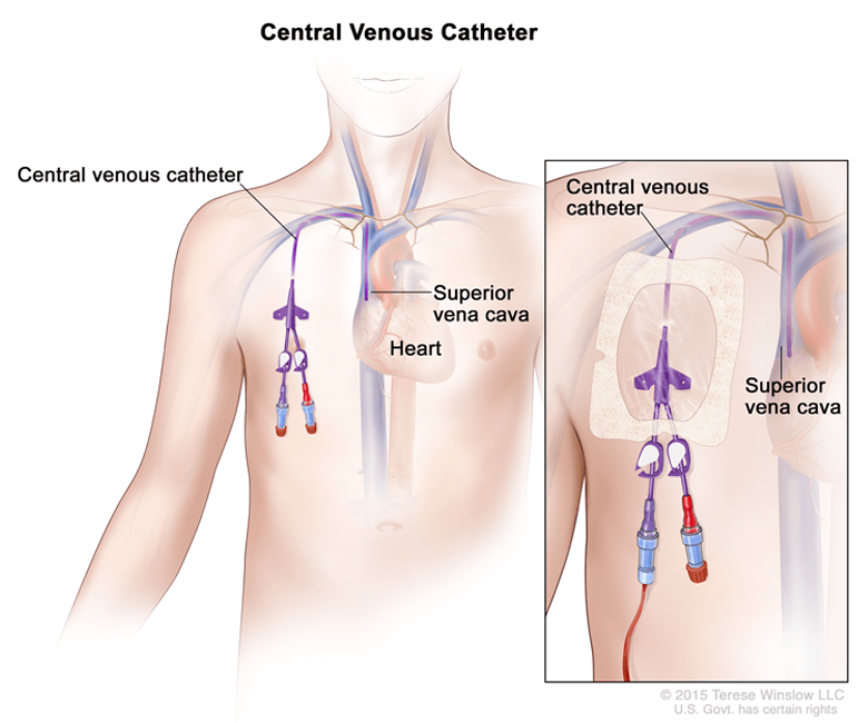 Arthur rækkevidde Mangle Tunneled Central Line (Tunneled Central Venous Catheter) | Children's  Hospital of Philadelphia