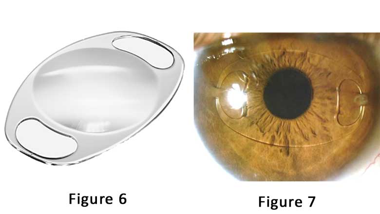 Pediatric Aphakia And Where To Place An Intraocular Lens - Figures 6 & 7
