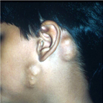 child with two pilomatrixoma