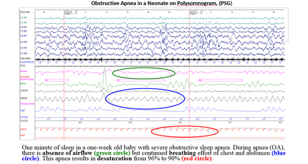 Obstructive Apnea in a Neonate on Polysomnogram, (PSG)